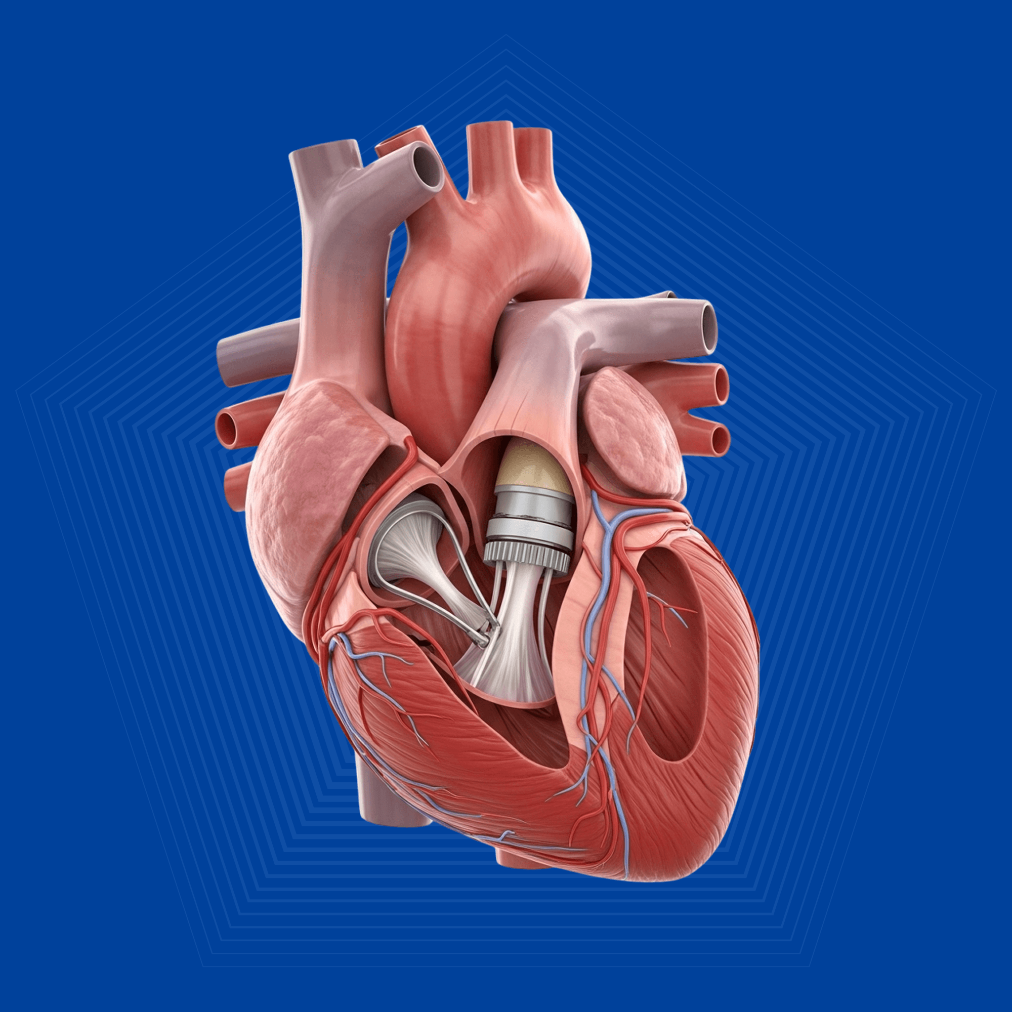 Heart Valve Replacement