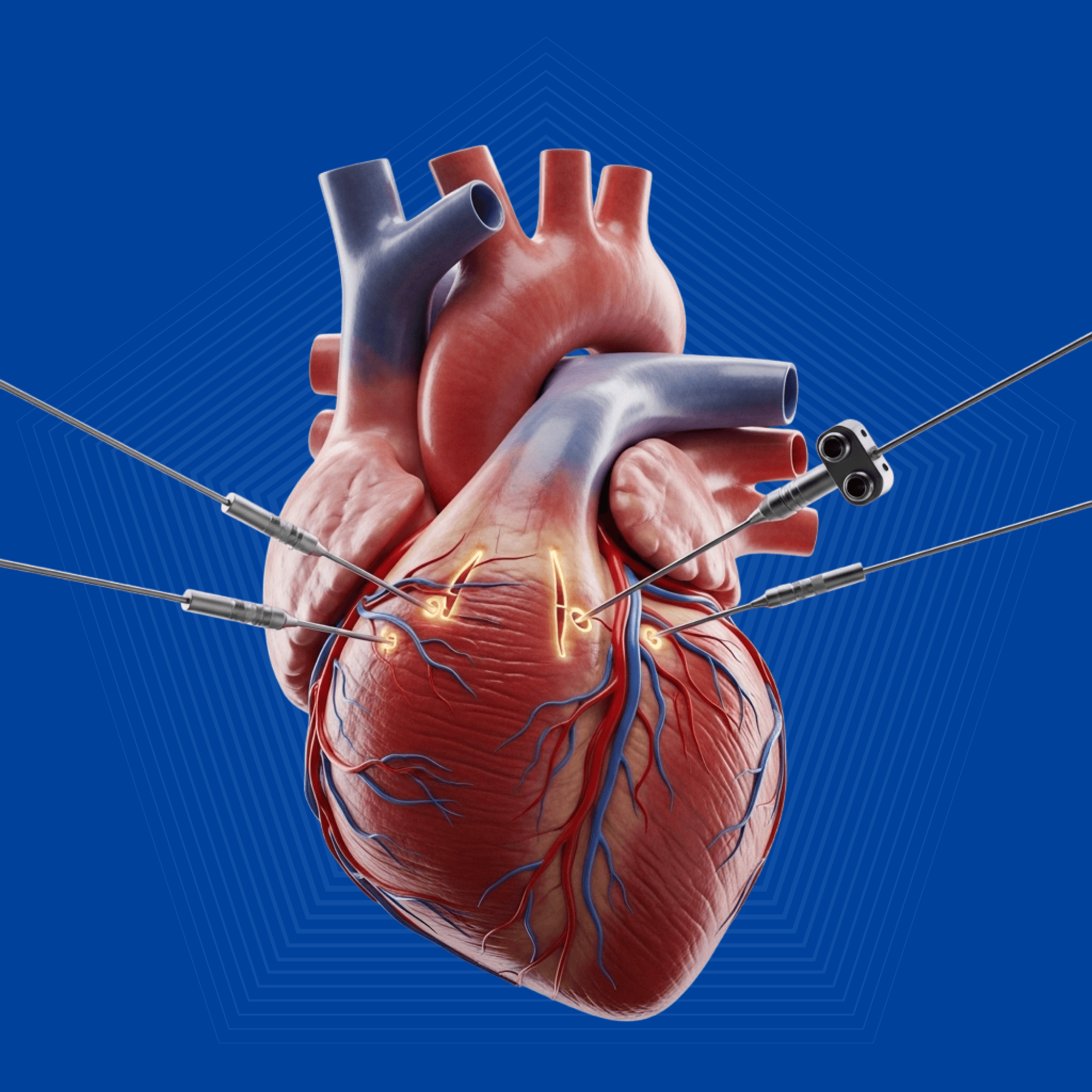 Aortic Aneurysm Repair
