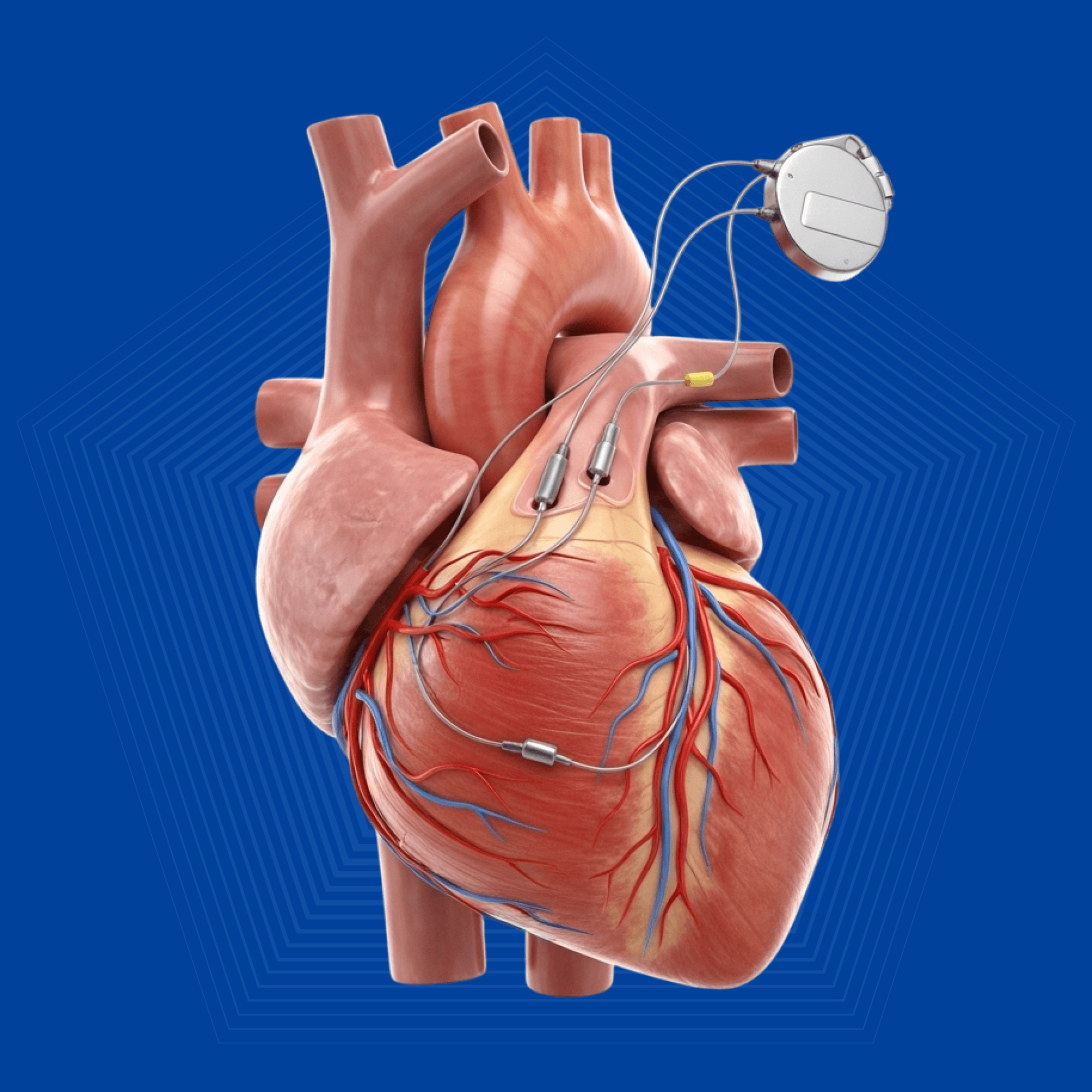Minimally Invasive Cardiac Surgery