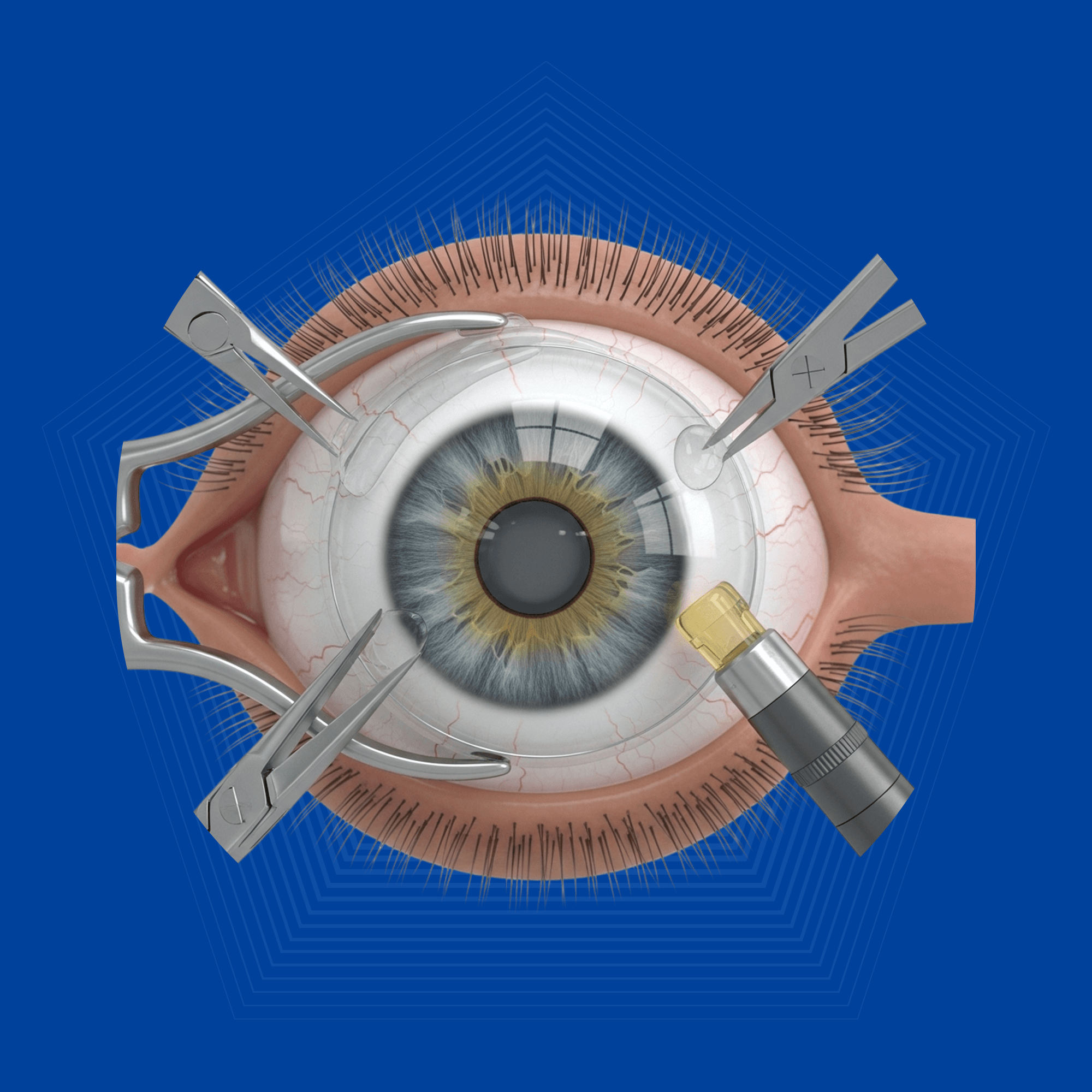 Glaucoma Surgery