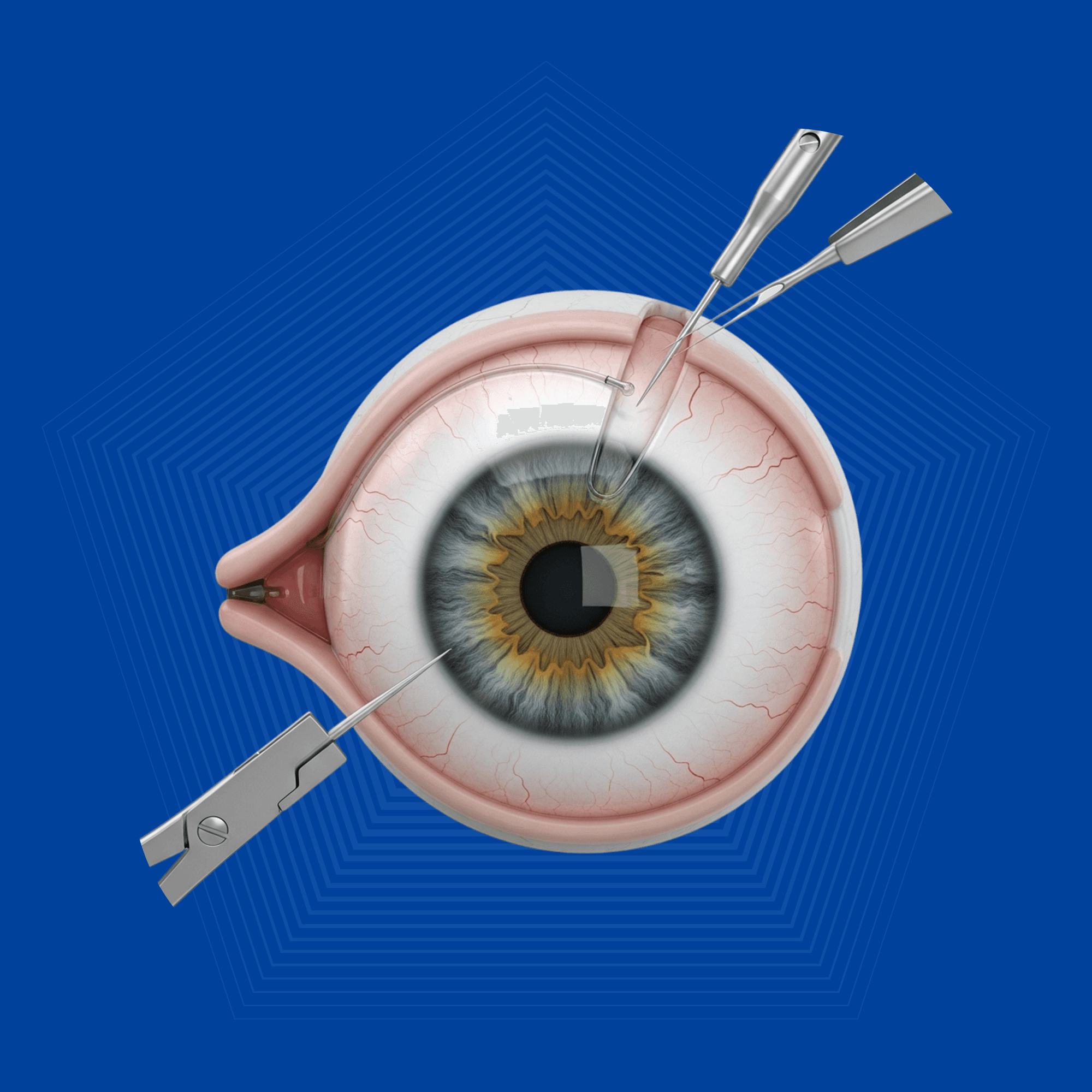 LASIK Eye Surgery