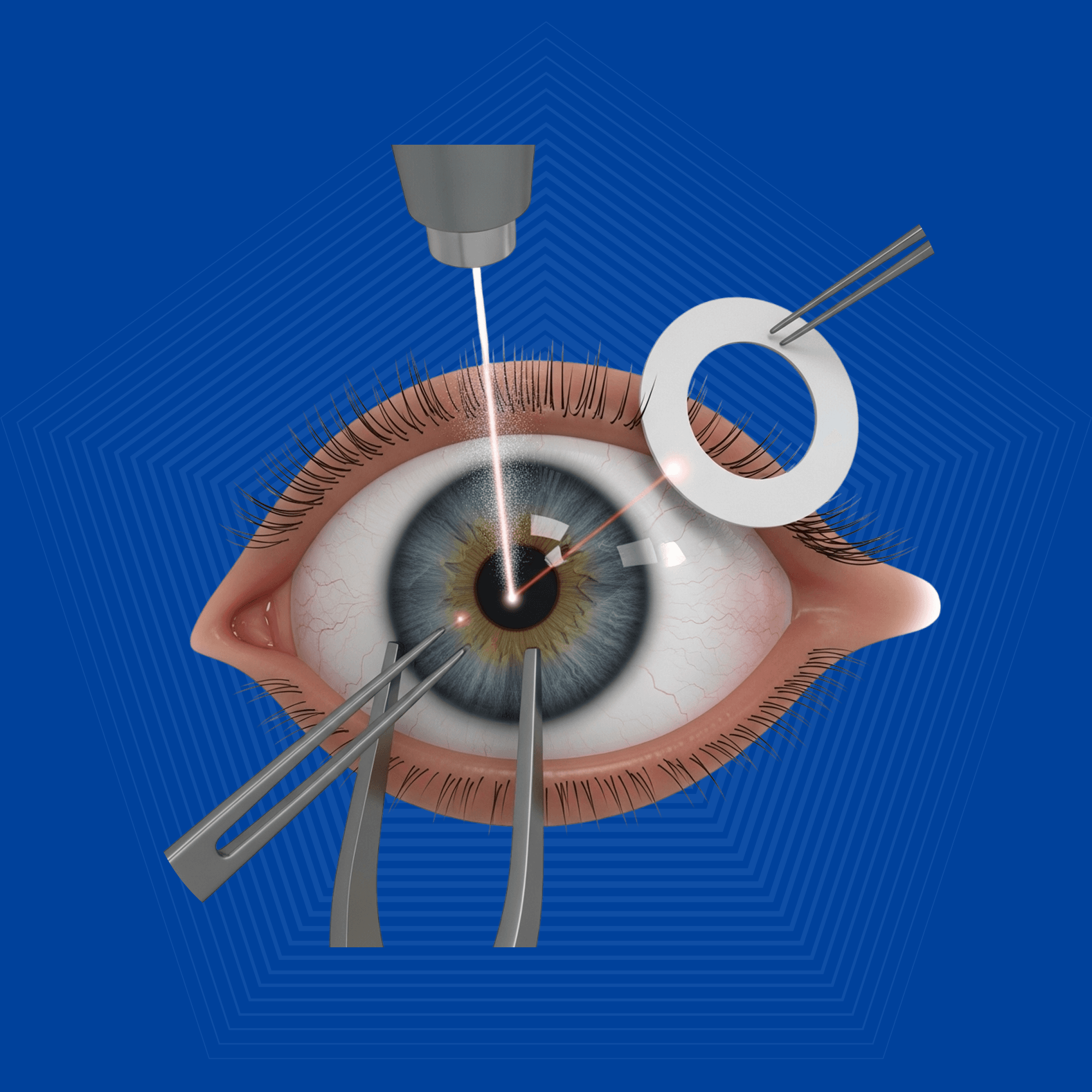 Cataract Surgery