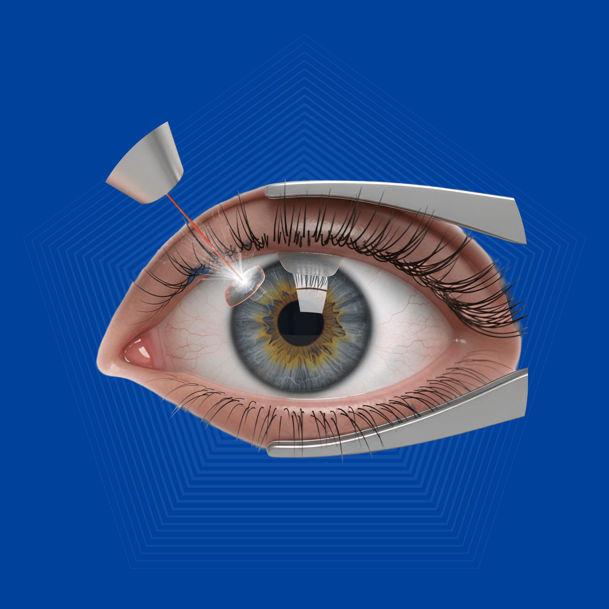 Lens Implant Surgery