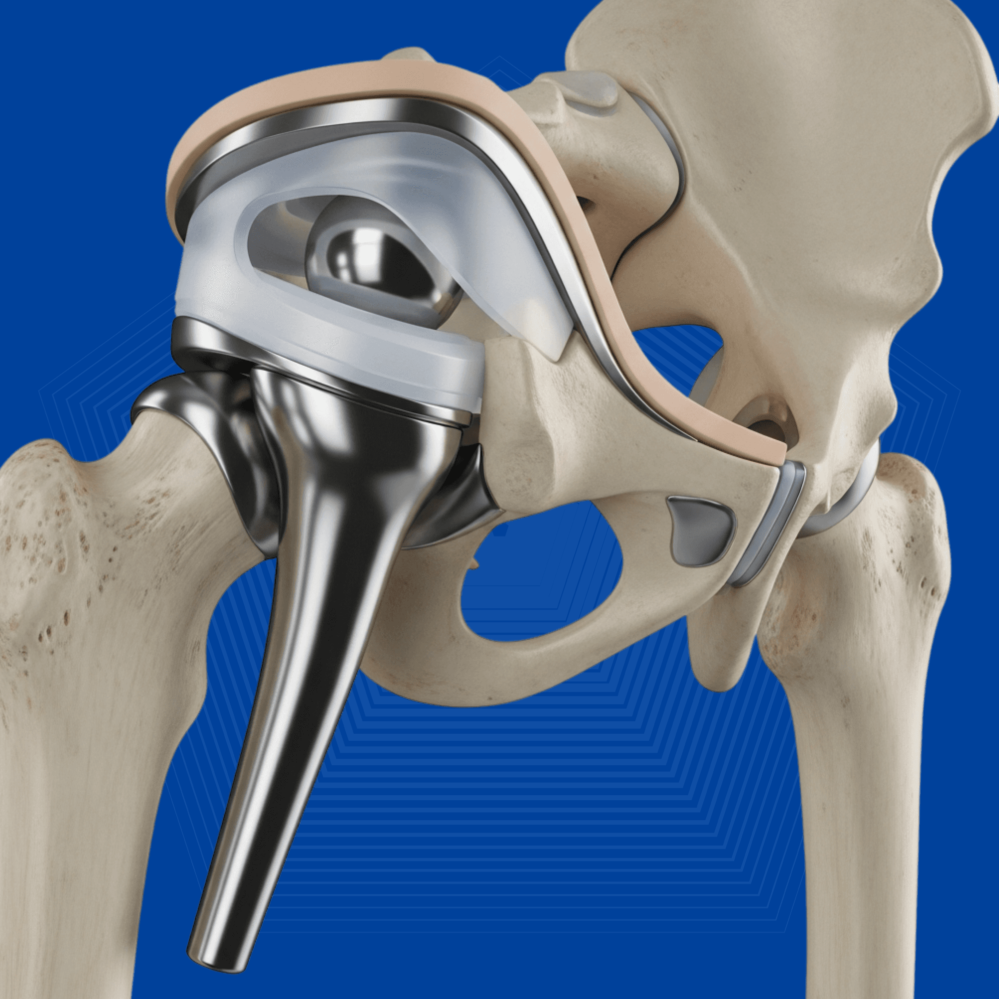 Hip Replacement